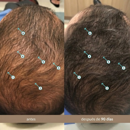 Sérum Avanzado De Densidad Capilar Con Nanoxidil 5%