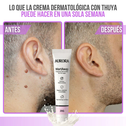 Wart Away™ Crema Eliminadora de Verrugas y Fibromas