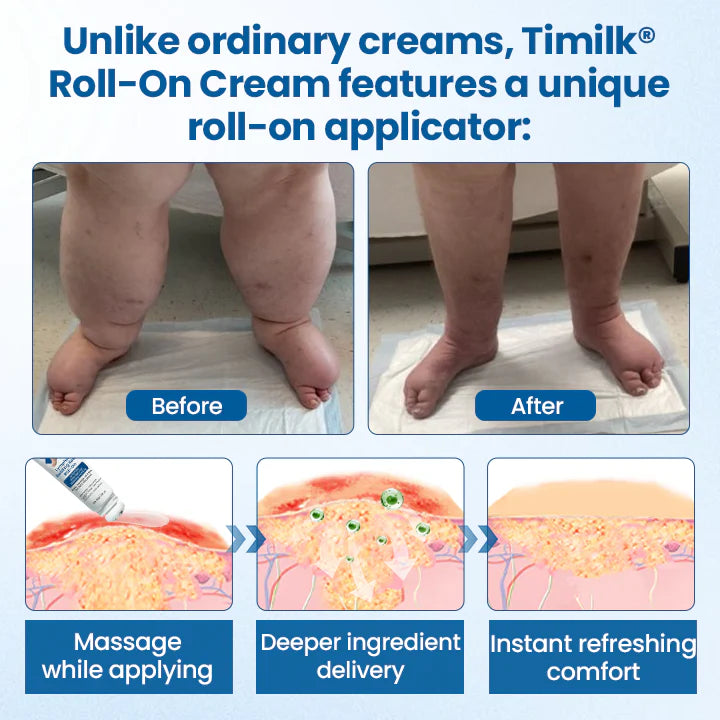 ¡OFERTA 2 X 1! Timilk® Roll-on Lymphora para el alivio de la hinchazón