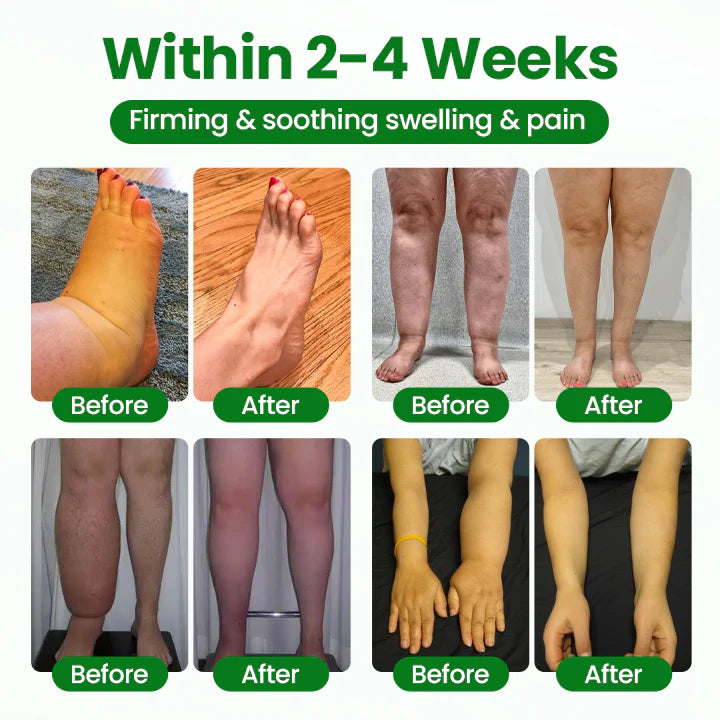 Timilk® VenoLift Spray para el alivio de piernas con edemas