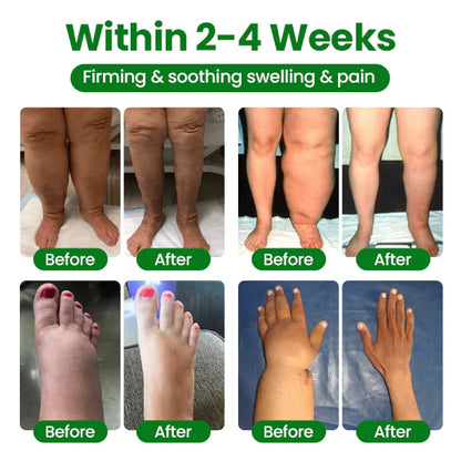 Timilk® VenoLift Spray para el alivio de piernas con edemas