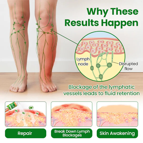 Timilk® VenoLift Spray para el alivio de piernas con edemas