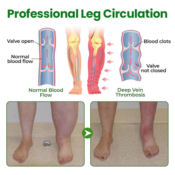 Timilk® VenoLift Spray para el alivio de piernas con edemas