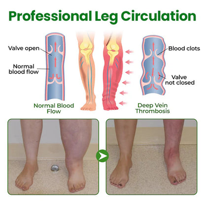 Timilk® VenoLift Spray para el alivio de piernas con edemas