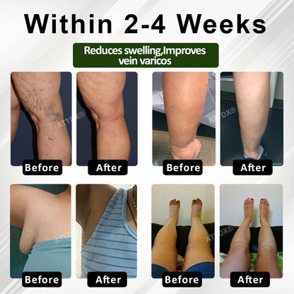 ATTDX® FluidEase Crema para el Edema de Piernas 3