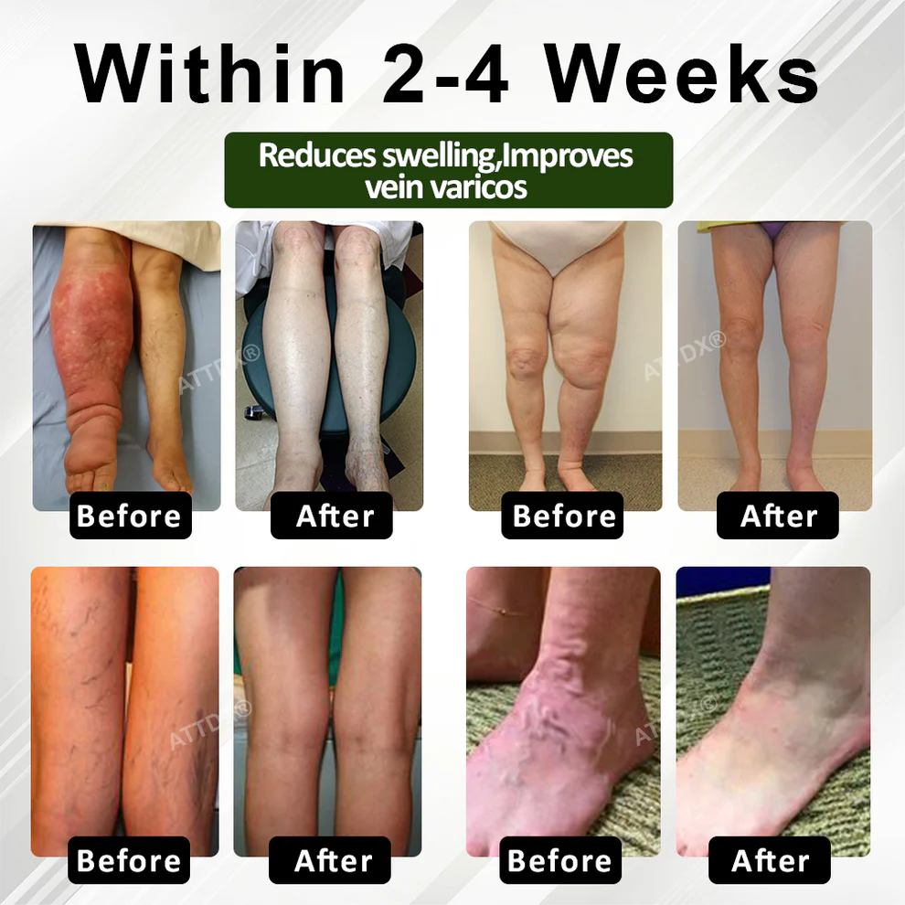ATTDX® FluidEase Crema para el Edema de Piernas 3