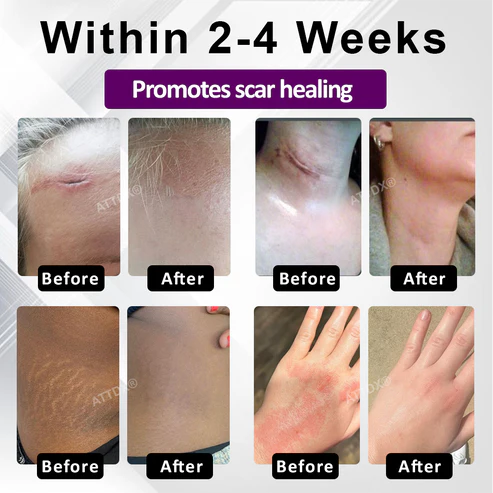 ¡OFERTA X3 GELS AVANZADOS PARA CICATRICES FACIALES Y CORPORALES ATTDX® NANOHEAL