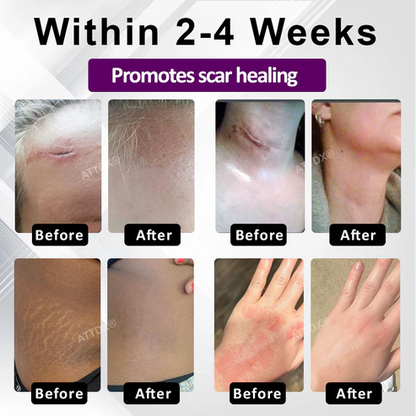 ¡OFERTA X3 GELS AVANZADOS PARA CICATRICES FACIALES Y CORPORALES ATTDX® NANOHEAL