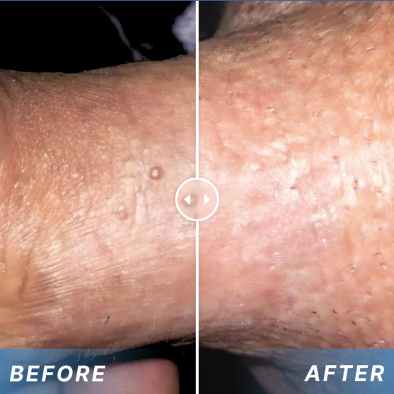 Crema para eliminar las verrugas genitales causadas por el VPH NanoLipo