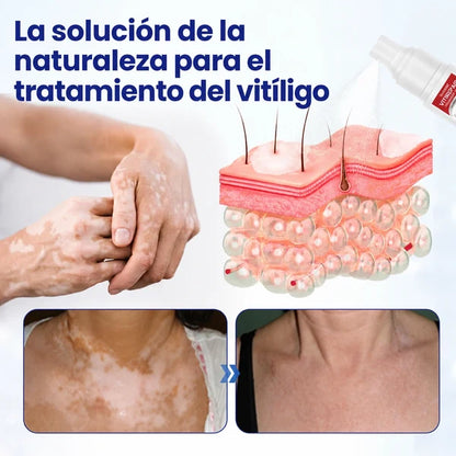 VitiRepair - Spray avanzado para el vitiligo y parches blancos