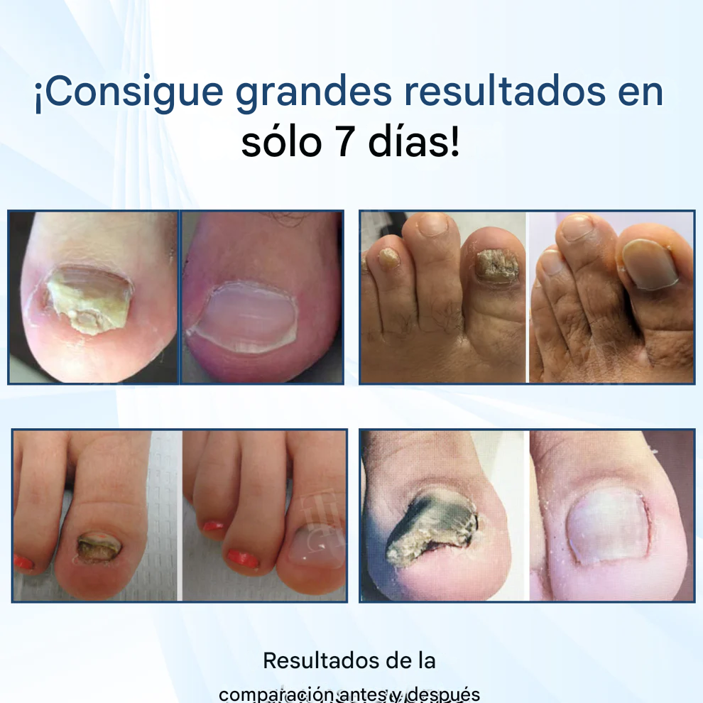 AEXZR® MycoShield Pro Apósitos para hongos en las uñas