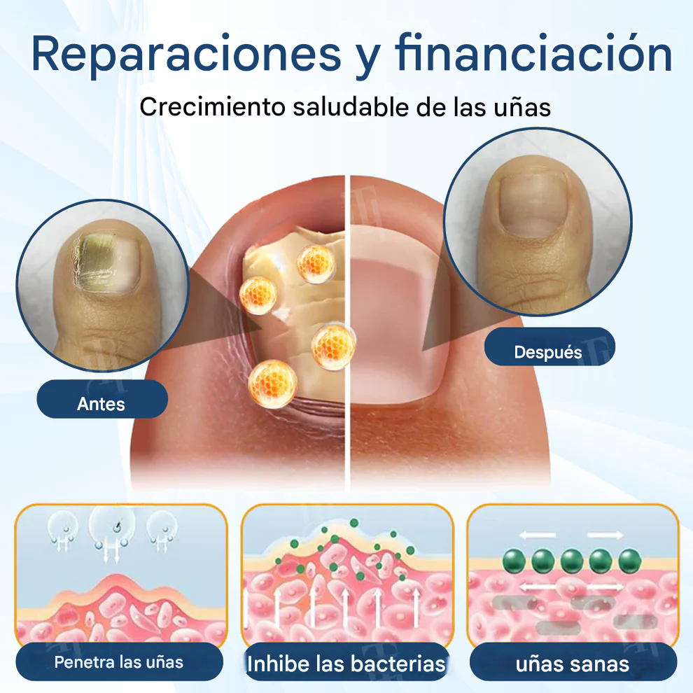 AEXZR® MycoShield Pro Apósitos para hongos en las uñas