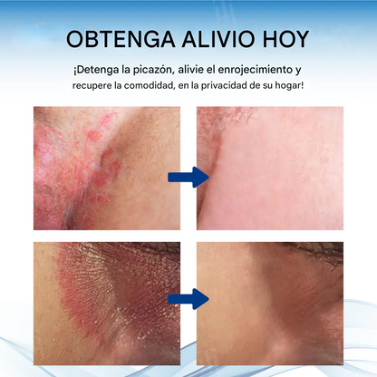 Crema Fivfivgo® para el tratamiento de la picazón en el escroto