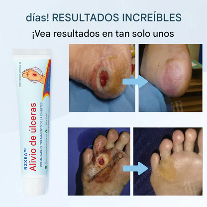 Crema para el tratamiento de la diabetes para el alivio de úlceras