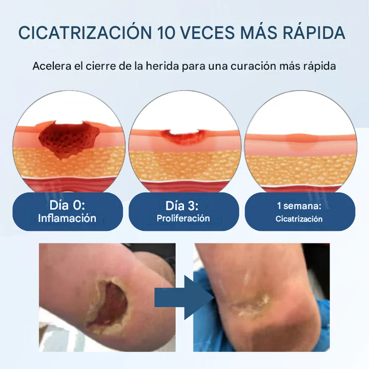 Crema para el tratamiento de la diabetes para el alivio de úlceras