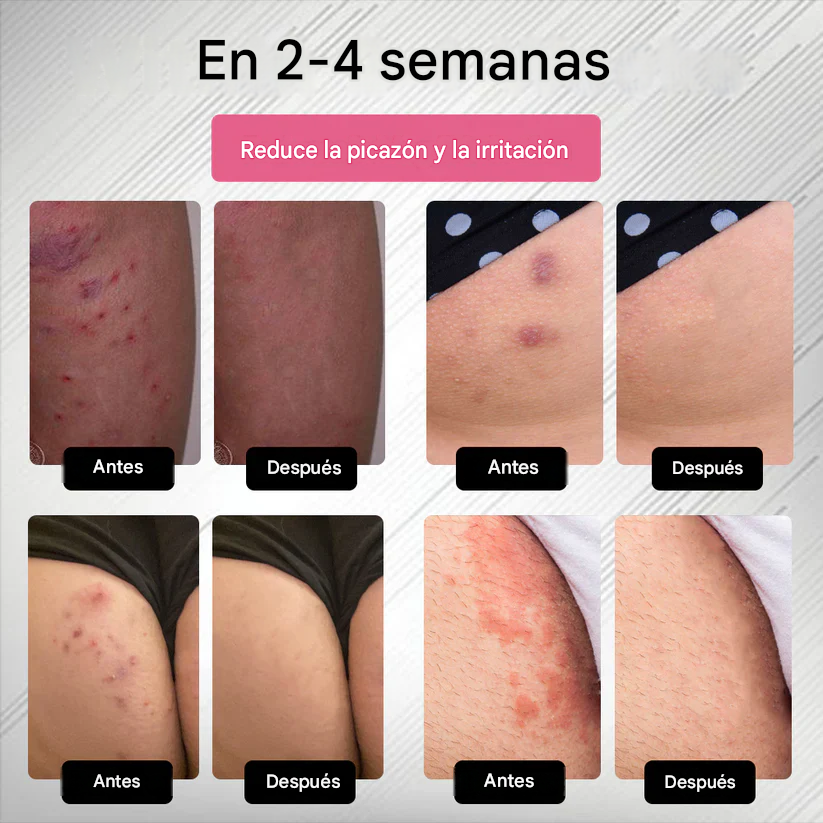 Spray para el cuidado de las verrugas genitales femeninas causadas por el VPH