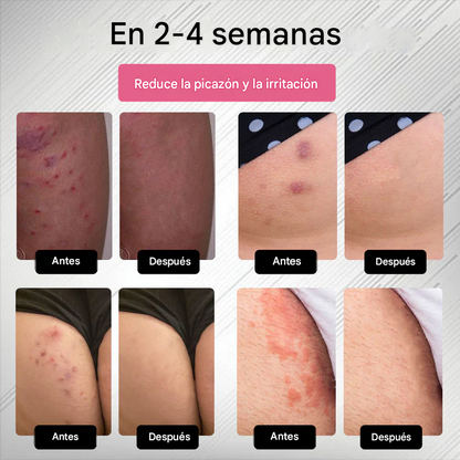 Spray para el cuidado de las verrugas genitales femeninas causadas por el VPH