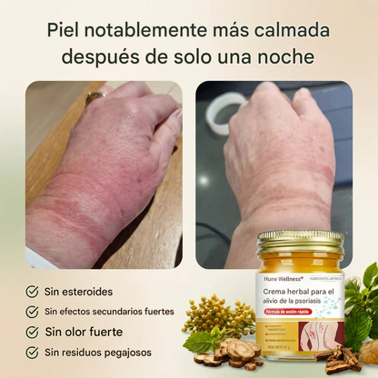 Crema herbal para el alivio de la psoriasis y el eczema