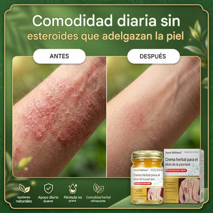Crema herbal para el alivio de la psoriasis y el eczema