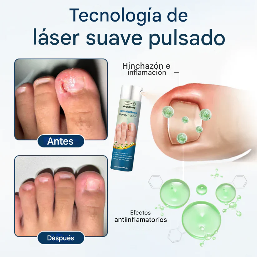 Spray herbal reparador de hongos Fivfivgo® OnyxiGuard