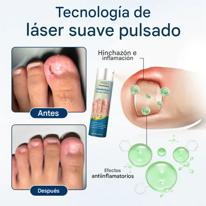 Spray herbal reparador de hongos Fivfivgo® OnyxiGuard