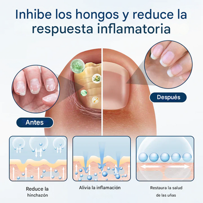 Spray herbal reparador de hongos Fivfivgo® OnyxiGuard