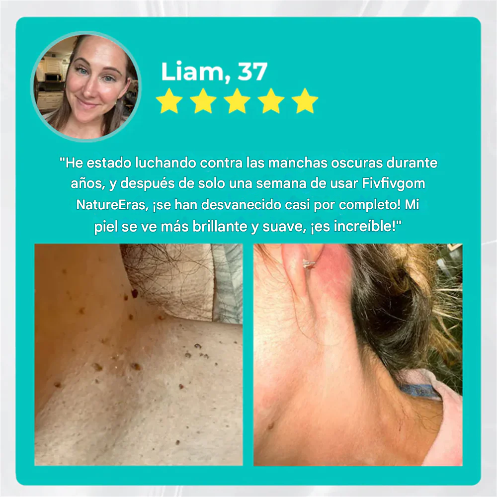 NatureErase Aceite de cocodrilo instantáneo Eliminador de lunares y manchas Plus Gel