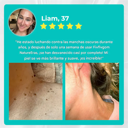 NatureErase Aceite de cocodrilo instantáneo Eliminador de lunares y manchas Plus Gel
