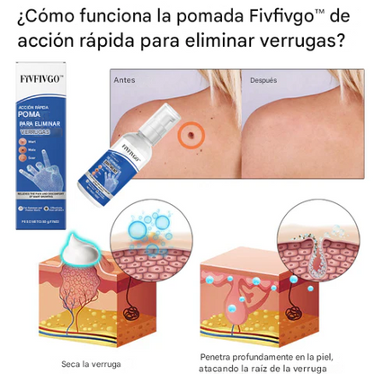Ungüento Fivfivgo™ de acción rápida para la eliminación de verrugas