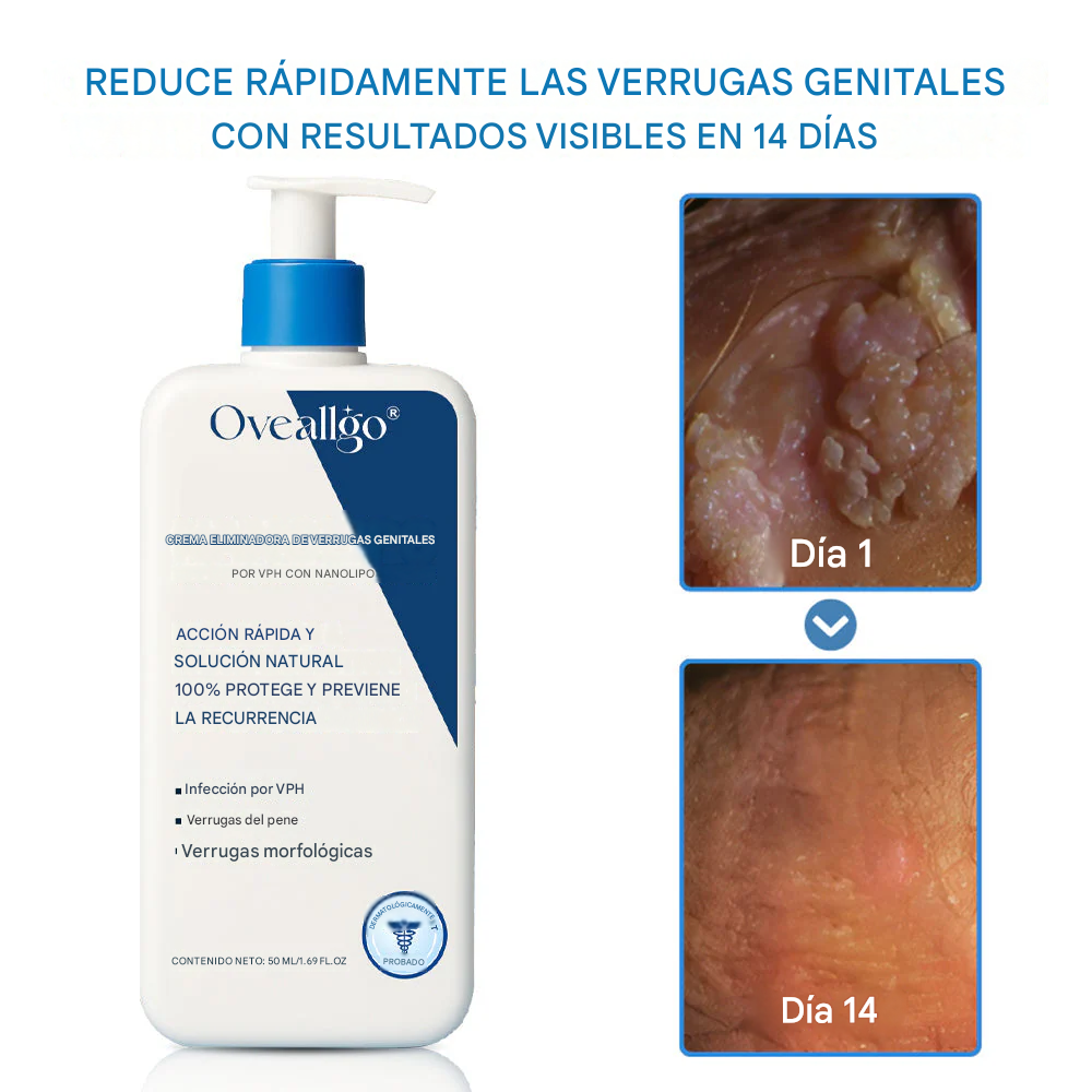 Crema para eliminar las verrugas genitales causadas por el VPH NanoLipo