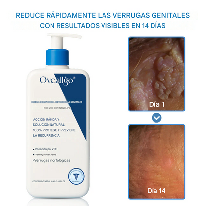 Crema para eliminar las verrugas genitales causadas por el VPH NanoLipo
