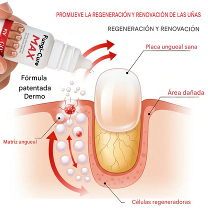 Fungi-Cure Max – Alivio de acción rápida para infecciones fúngicas de las uñas