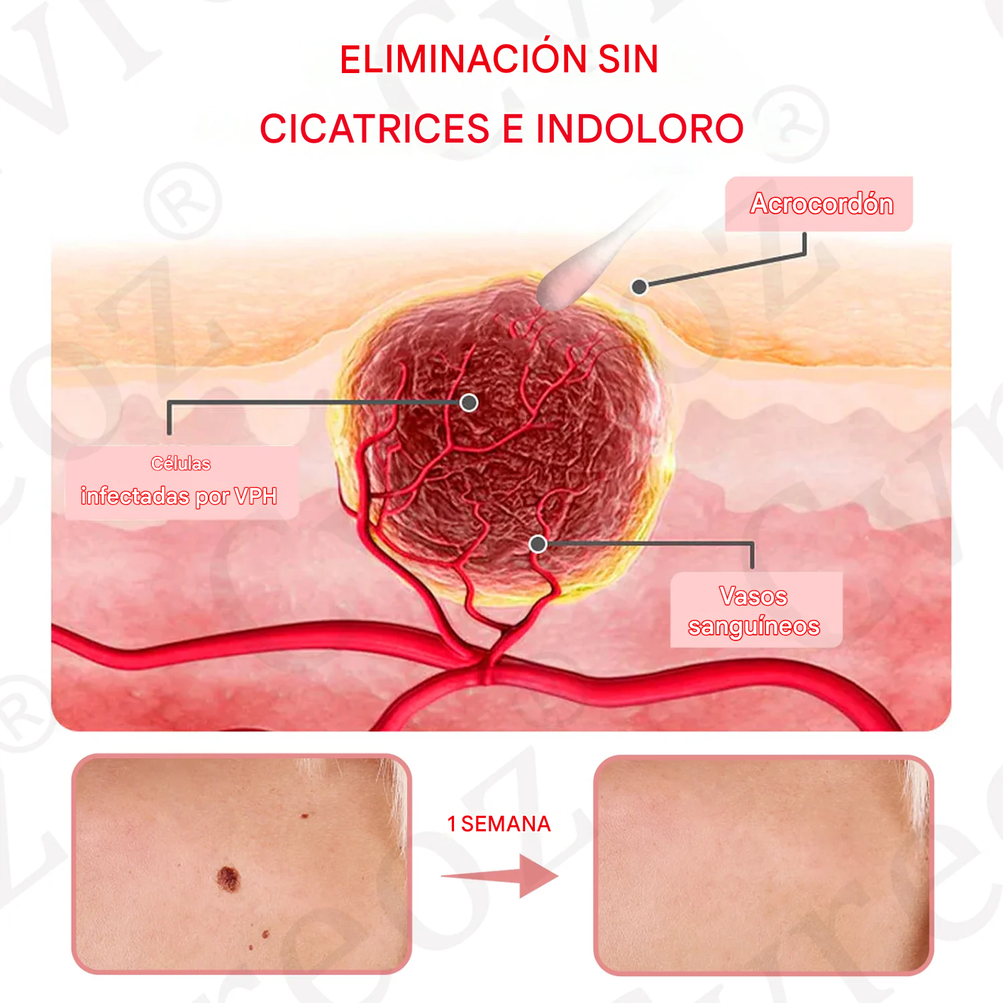Suero de doble ácido para la eliminación de verrugas y lunares