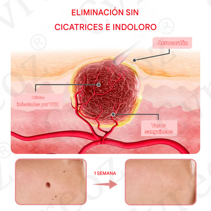 Suero de doble ácido para la eliminación de verrugas y lunares