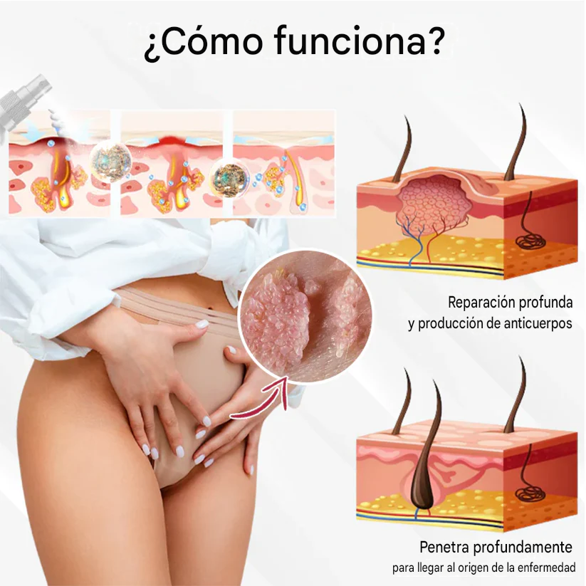 Spray para el cuidado de las verrugas genitales femeninas causadas por el VPH