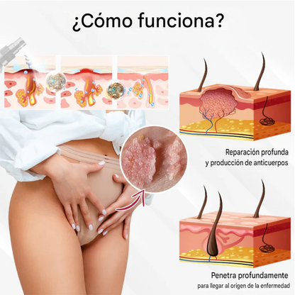 Spray para el cuidado de las verrugas genitales femeninas causadas por el VPH