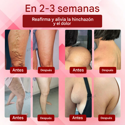Crema de masaje para drenaje linfático ATTDX® EdemaCare