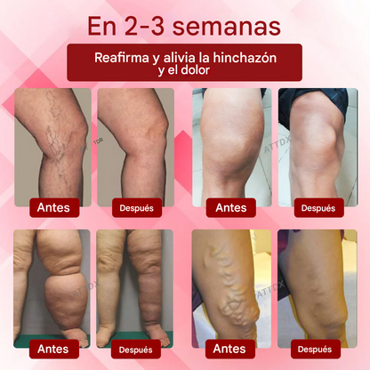 Crema de masaje para drenaje linfático ATTDX® EdemaCare