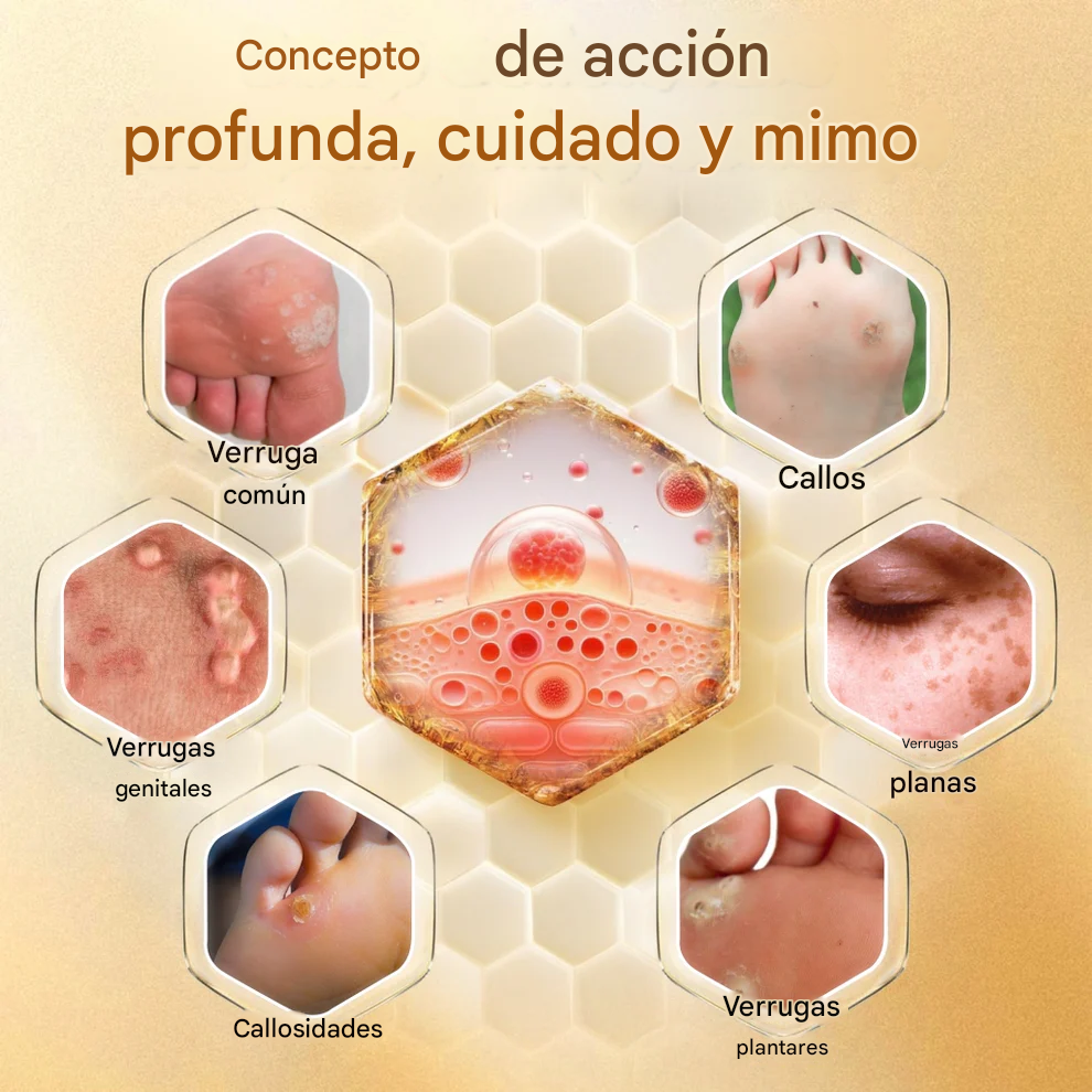 Crema para eliminar callos y verrugas con veneno de abeja