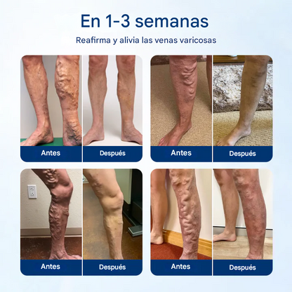Timilk® VenoRelief Spray Botánico para Piernas