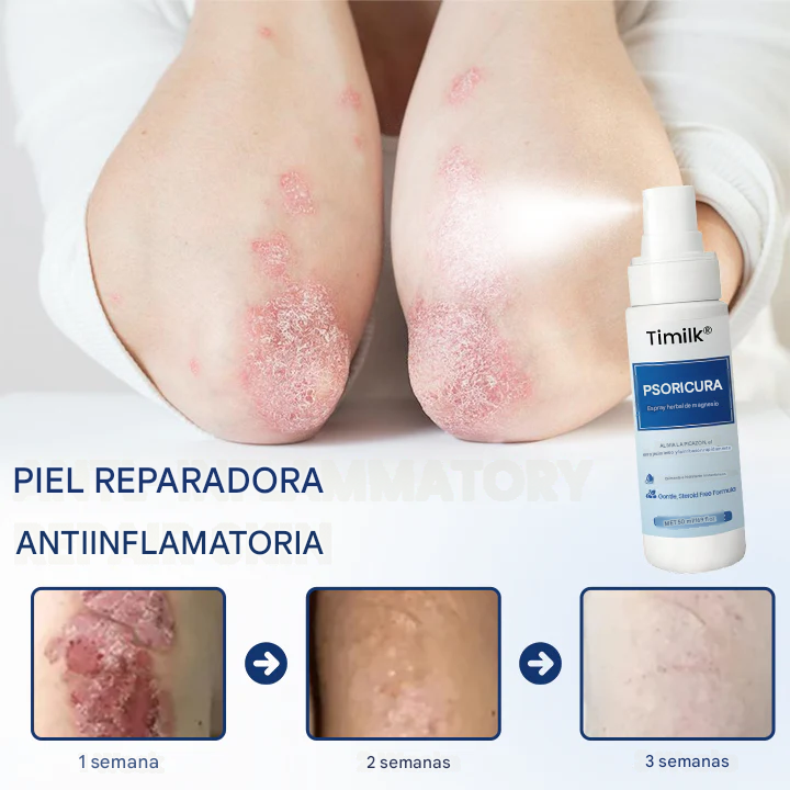 Timilk® PsoriCure Spray herbal de magnesio