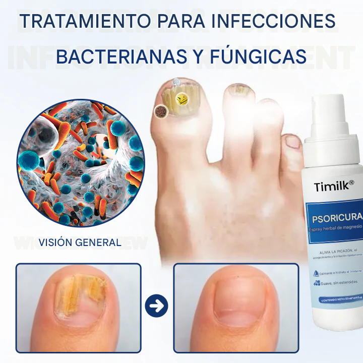 Timilk® PsoriCure Spray herbal de magnesio