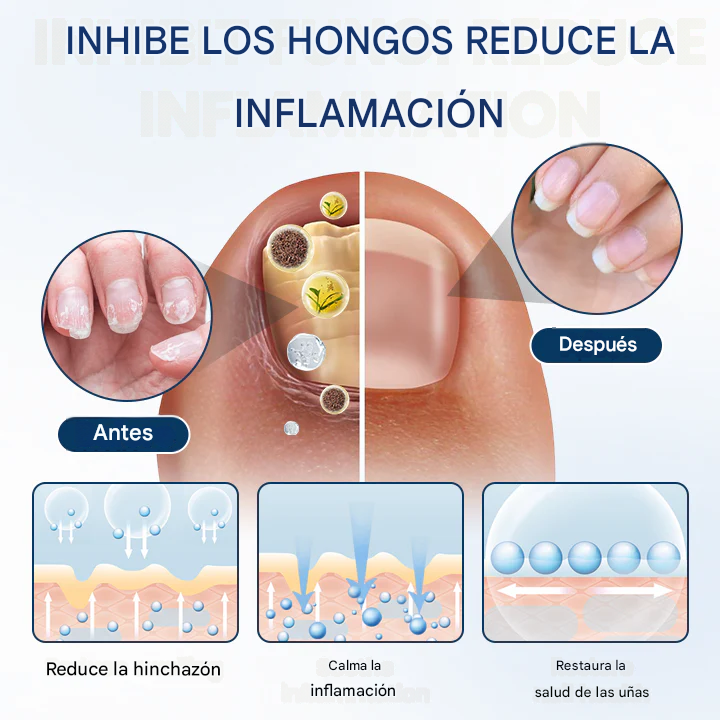 Timilk® PsoriCure Spray herbal de magnesio