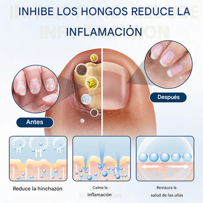 Timilk® PsoriCure Spray herbal de magnesio