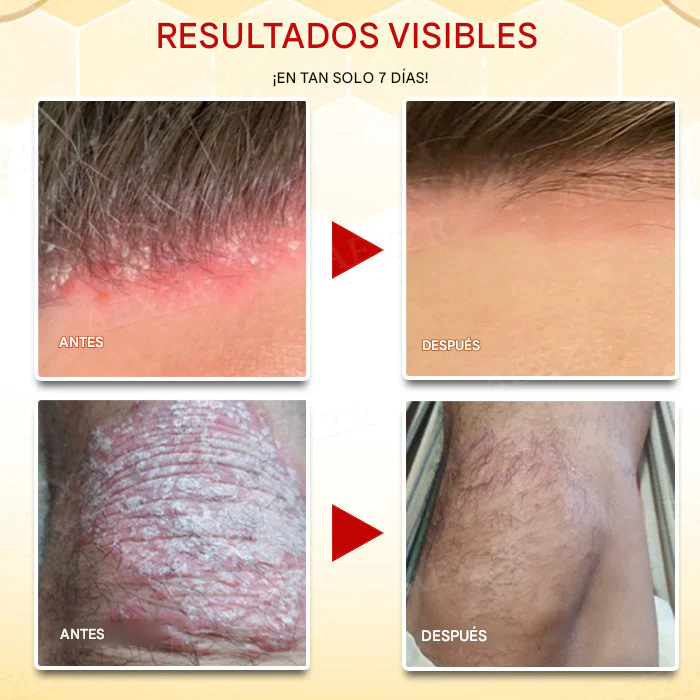 Crema para el tratamiento de la psoriasis con veneno de abeja