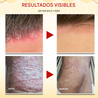 Crema para el tratamiento de la psoriasis con veneno de abeja