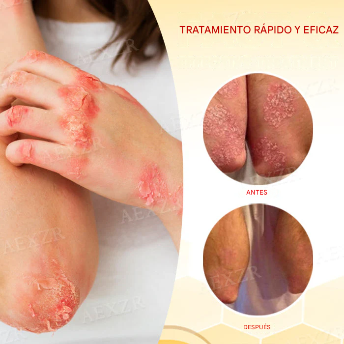 Crema para el tratamiento de la psoriasis con veneno de abeja