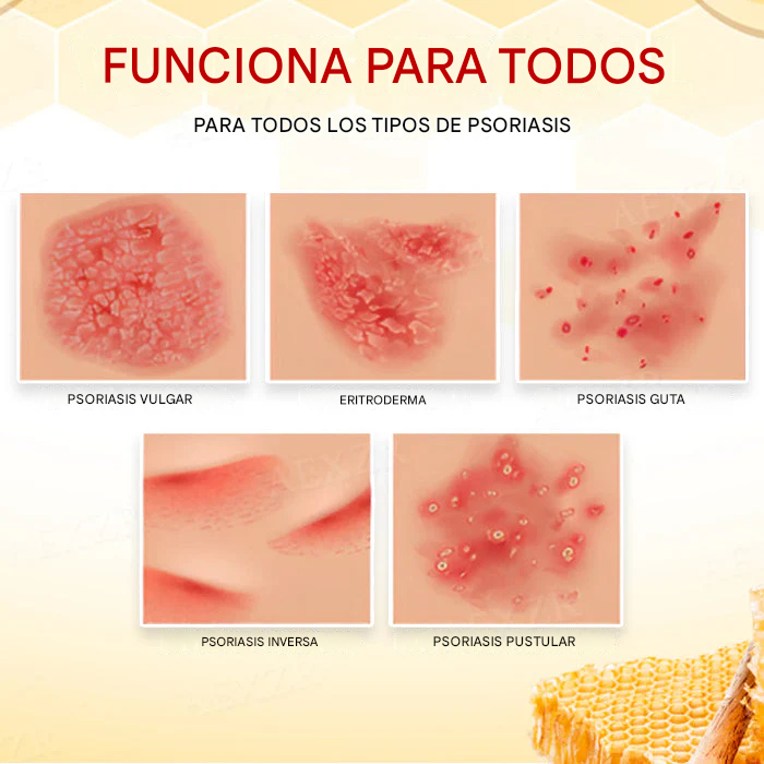 Crema para el tratamiento de la psoriasis con veneno de abeja