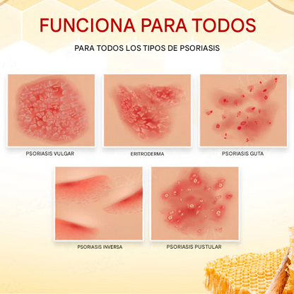 Crema para el tratamiento de la psoriasis con veneno de abeja