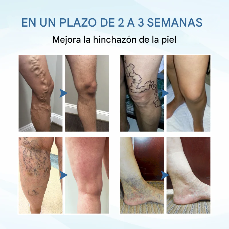 TIMILK® THERAVEIN SPRAY HERBAL PARA VARICES